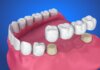 Types Of A Dental Crown Dental Crown