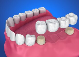 Types Of A Dental Crown Dental Crown