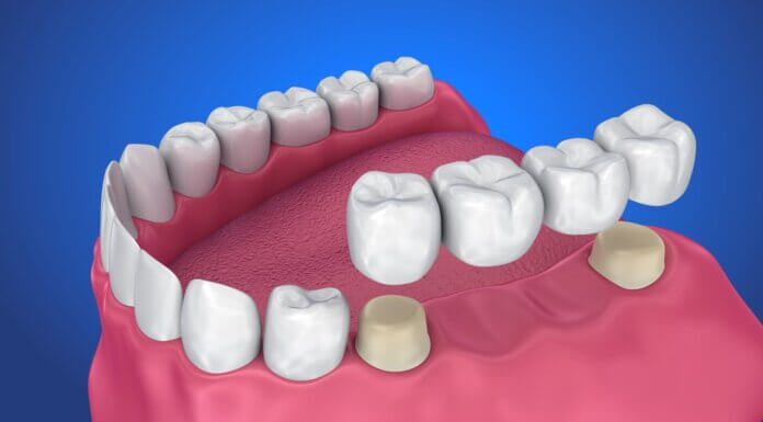 Types Of A Dental Crown Dental Crown