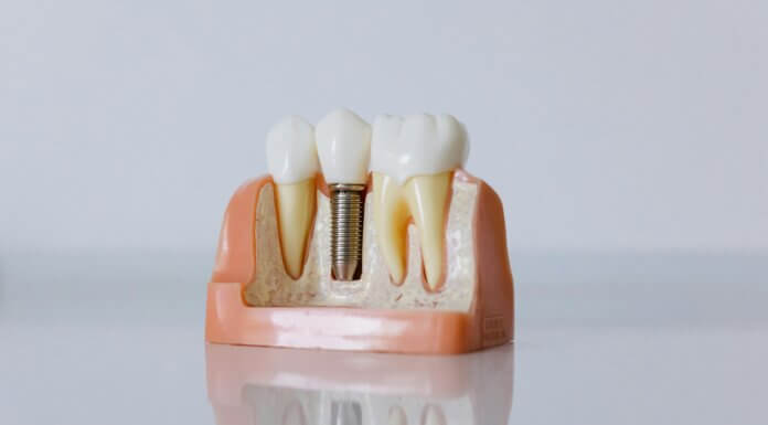 Step-by-Step Process in Getting Dentures at a Clinic denture implants