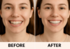 What to Expect from Clear Aligners Before and After Treatment Clear Aligners Before and After