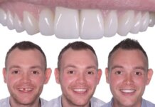 How to Choose the Right Teeth Replacement Melbourne Clinic