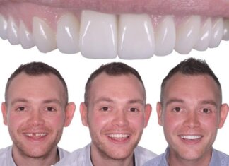 How to Choose the Right Teeth Replacement Melbourne Clinic