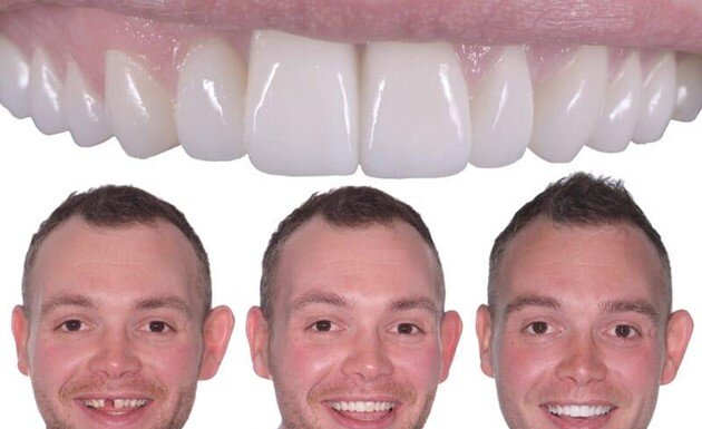 How to Choose the Right Teeth Replacement Melbourne Clinic