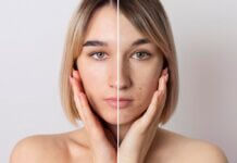 Why Understanding Skin Types is Crucial for Biostimulators Usage