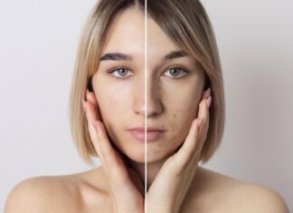 Why Understanding Skin Types is Crucial for Biostimulators Usage
