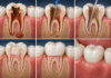 How Root Canal Treatment Saves Infected Teeth root canal treatment