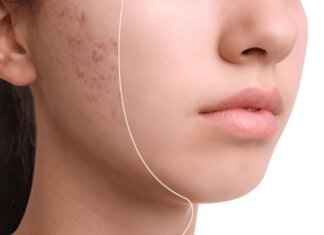 Scar Removal Melbourne: Expert Advice for Smooth, Clear Skin scar removal melbourne