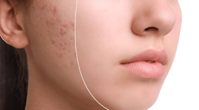 Scar Removal Melbourne: Expert Advice for Smooth, Clear Skin scar removal melbourne