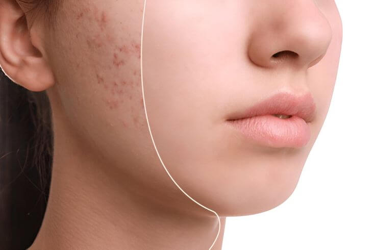 74901594180019cecfd52487db98dab3 scar removal melbourne