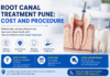 Root Canal Treatment Pune: Cost and Procedure Root Canal Treatment Pune